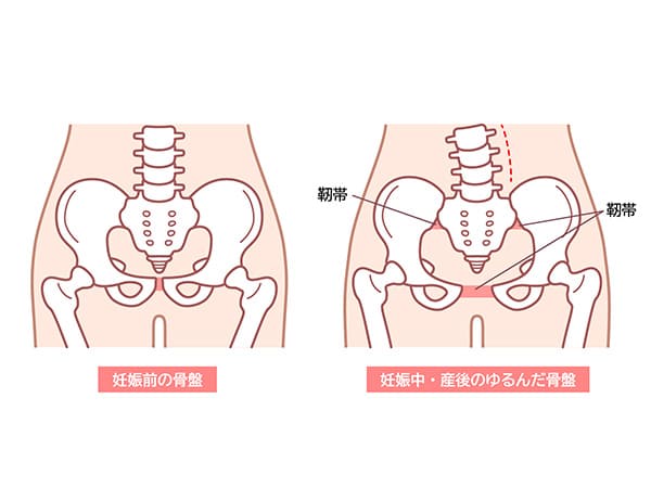 妊娠前と産後の骨盤のゆがみイラスト